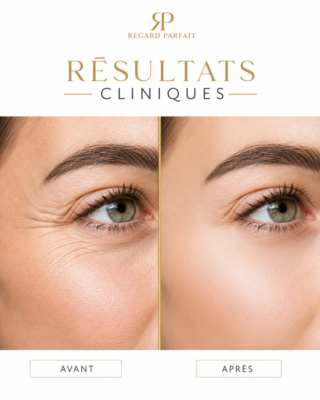 REGARD PARFAIT - Patchs Yeux Micro-Aiguilles Acide Hyaluronique