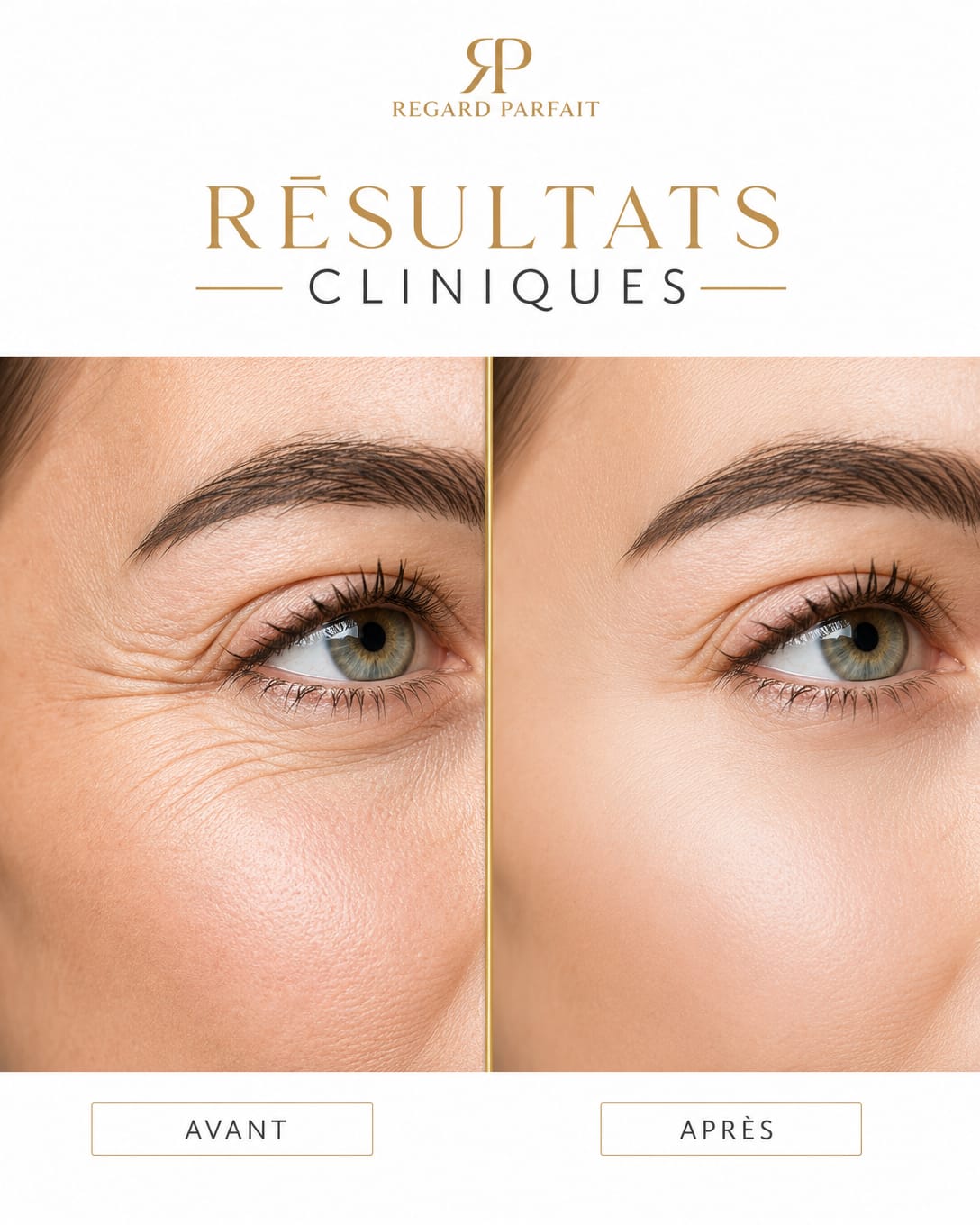 REGARD PARFAIT - Patchs Yeux Micro-Aiguilles Acide Hyaluronique